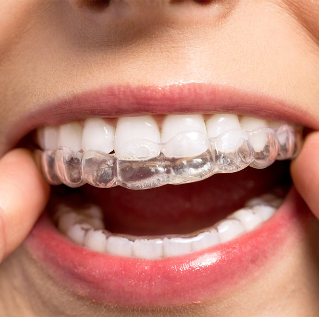 invisalign braces clear corpus tx christi does tray aligners dentist patient